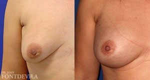 Lipoinyección mamaria
