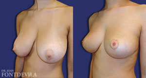 reducción de mamas
